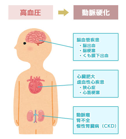 本態性高血圧