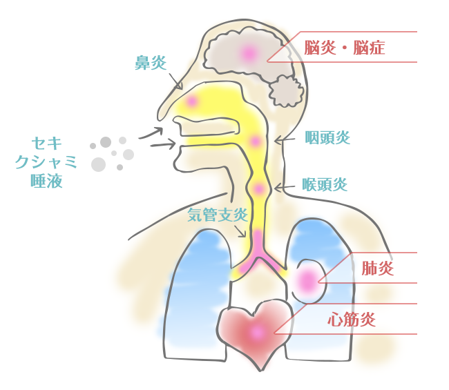 インフルエンザの主な症状と合併症