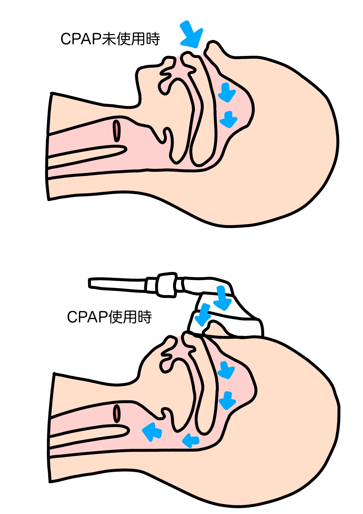 閉塞型睡眠時無呼吸症候群
